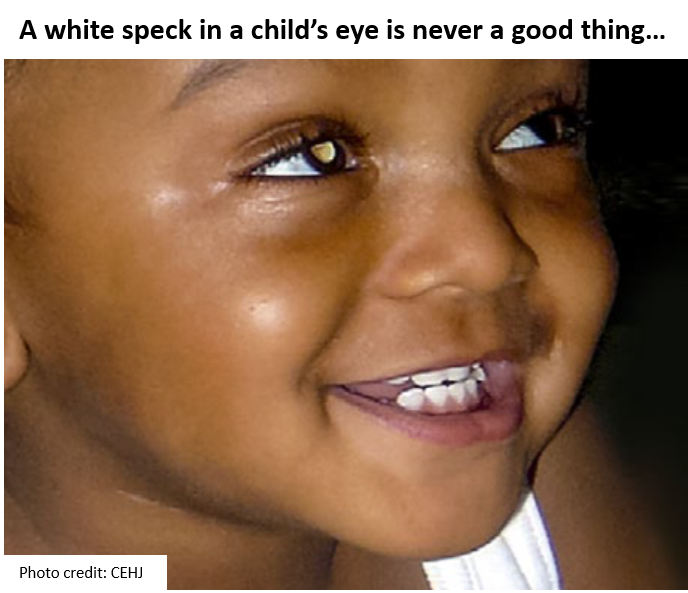 That white speck could be Retinoblastoma! || Eyehub Nigeria